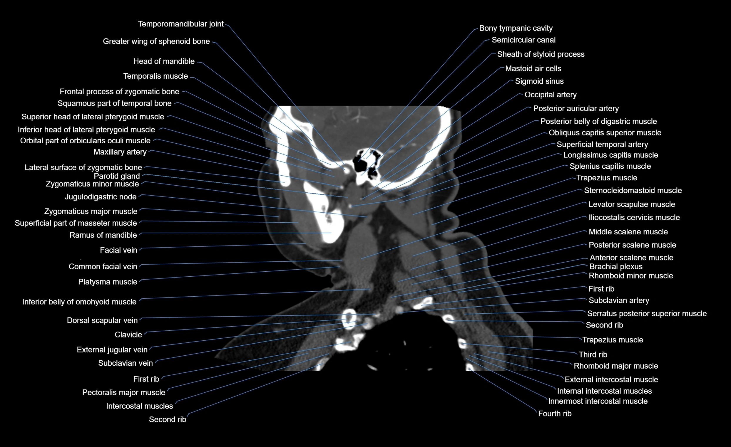 Neck CT sagittal cross sectional anatomy 3D  radiology  image-img-00001-00016.webp